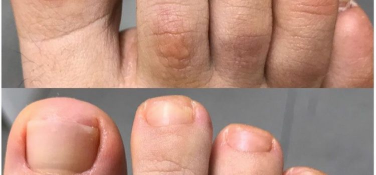 ¿TIENES MANCHAS EN LAS UÑAS?