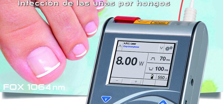 El láser, una terapia segura y eficaz ante las onicomicosis El láser, una terapia segura y eficaz ante las onicomicosis