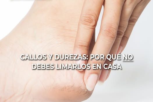 Callos y Durezas en los Pies: ¿Por Qué No Debemos Quitarlos en Casa? Callos y Durezas en los Pies: ¿Por Qué No Debemos Quitarlos en Casa?