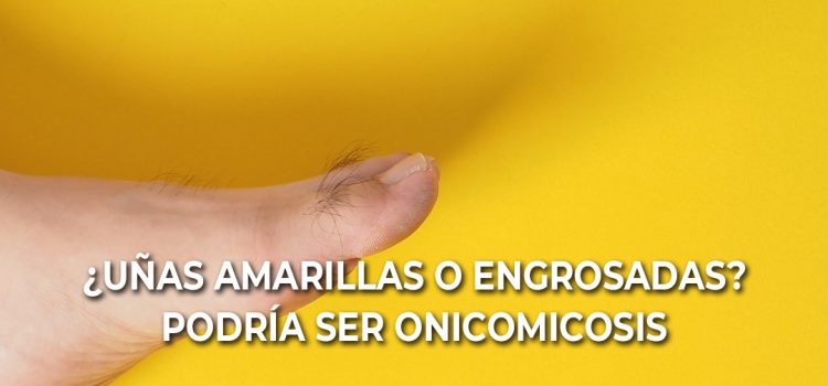 Uñas amarillas y engrosadas: causas, onicomicosis y tratamiento podológico Uñas amarillas y engrosadas: causas, onicomicosis y tratamiento podológico