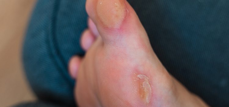 Ampollas en los pies: cómo tratarlas y cuándo acudir al podólogo Ampollas en los pies: cómo tratarlas y cuándo acudir al podólogo
