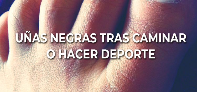 Uñas negras tras caminar o hacer deporte: ¿por qué aparecen?