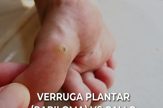 Verrugas plantares (papilomas) vs callos: cómo diferenciarlos y tratamientos efectivos en Podología Julia Franco