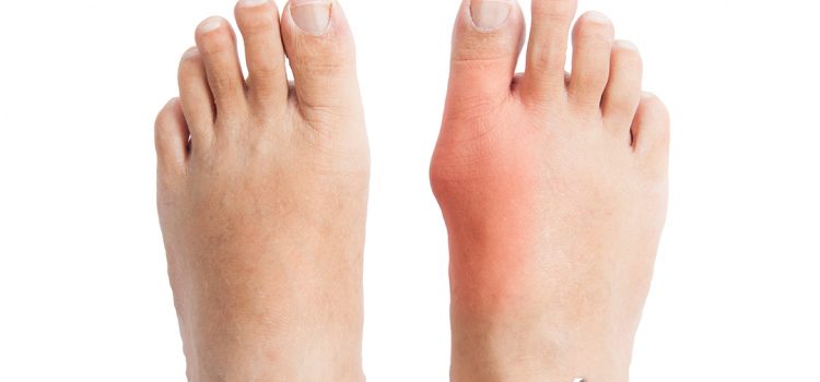 Juanetes: causas, síntomas y por qué algunos zapatos provocan tanto dolor